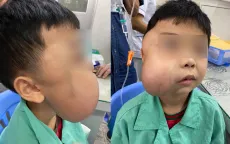 Cắt bỏ khối u xơ vòm mũi họng khổng lồ cho bé trai 13 tuổi