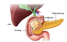 Phẫu thuật nội soi cắt khối tá tụy - Bước tiến mới trong điều trị ung thư vùng đầu tụy tá tràng