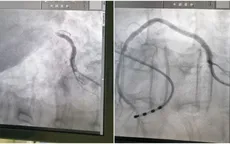 Cứu bệnh nhân nhồi máu cơ tim cấp biến chứng sốc tim, ngừng tuần hoàn