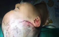 Bé 2 tuổi bị chó cắn với các vết thương nặng