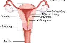 Quá sản nội mạc tử cung tiến triển thành ung thư vì không điều trị sớm