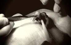 Một phụ nữ đứt lìa trụ mũi sau khi tin "bác sĩ" thẩm mỹ dạo