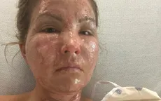 Dùng nước rửa tay khô không rõ nguồn gốc, một phụ nữ Mỹ bị bỏng nặng