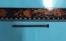 Lấy đinh sắt dài gần 8cm nằm ở vùng cổ, đâm thủng động mạch dưới đòn