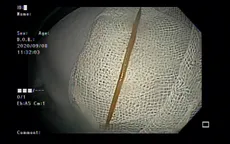 Đi khám vì đau bụng, cụ ông phát hiện tăm dài 5cm đâm vào tá tràng
