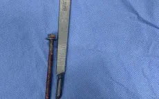 Phẫu thuật lấy dị vật dài 6cm khỏi cơ quan sinh dục người đàn ông.