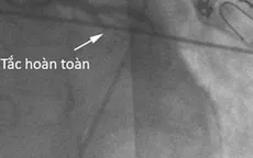 Cứu 2 bệnh nhân ngừng tuần hoàn hô hấp do nhồi máu cơ tim