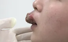 Môi đóng vảy, biến dạng vì phản ứng cấp tính sau phun xăm