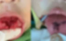 Ngã từ trên giường xuống đất, trẻ 1 tuổi bị rách lưỡi