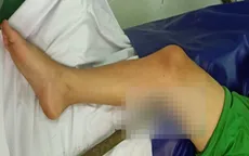 Ngã khi leo cây, bé trai bị cành cây đâm xuyên đùi