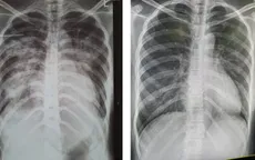 Cứu sống sản phụ bị phù phổi cấp do tiền sản giật nặng