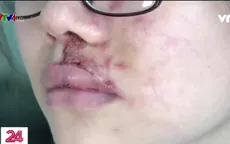 Vẹo mũi, hỏng tai vì thẩm mỹ "chui" hoành hành