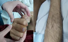 Chủ quan vết xước nhỏ ở tay, người đàn ông nguy kịch