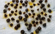 Phẫu thuật nội soi cắt túi mật chứa hơn 80 viên sỏi