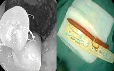 Hi hữu: Gắp cây nến trong trực tràng bé 5 tháng tuổi