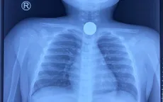 Bé 5 tuổi nhập viện cấp cứu vì nuốt đồng xu