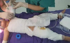Bé 3 tuổi bỏng nặng do ngã vào nồi nước nóng