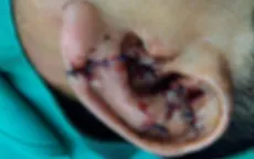 Va vào tường, người đàn ông bị đứt lìa tai