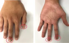 Nam thanh niên 20 tuổi bị hoại tử ruột non do hội chứng Peutz Jeghers