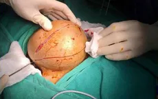 Bướu giáp khổng lồ - Chớ nên xem thường