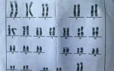 Bé gái bị phì đại âm vật phẫu thuật ở lứa tuổi trễ