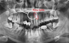 Sưng đau môi trên lâu ngày: Cẩn trọng có thể bạn mắc u xương hàm