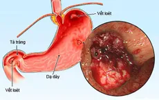 Phụ thuộc corticoid - bài học đắt giá
