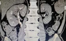 Phẫu thuật điều trị cho bệnh nhân ung thư tế bào thận dạng Sarcoma