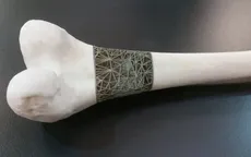 Xương nhân tạo in 3D mang lại hy vọng mới cho bệnh nhân