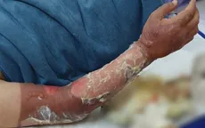 Đốt rác bằng xăng, người đàn ông bỏng nặng vùng mặt, cẳng tay