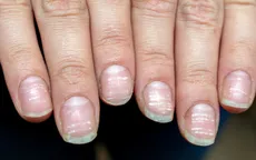 COVID-19: Triệu chứng đáng chú ý ở móng tay và chân