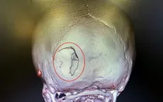 Phẫu thuật cứu bệnh nhi 4 tuổi bị mảnh vỡ xương sọ găm xuyên não