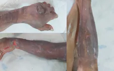 Trị liệu oxy cao áp hiệu quả cho bệnh nhân bị bỏng xăng nặng