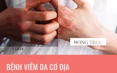 Bệnh viêm da cơ địa và những lưu ý quan trọng
