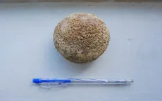 Phẫu thuật lấy sỏi kích thước 9cm trong bàng quang bệnh nhân