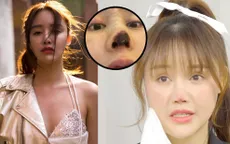 Nữ diễn viên Trung Quốc bị hoại tử mũi do phẫu thuật khuyên các cô gái cẩn thận khi làm đẹp