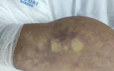 Cảnh báo một trường hợp nhiễm liên cầu lợn tiên lượng xấu