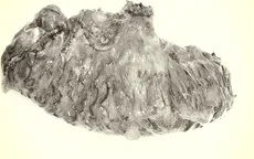 Điều trị khỏi hoàn toàn ung thư đại tràng cho bệnh nhân