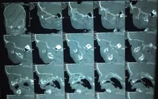 Phẫu thuật dị tật tắc cửa mũi sau bẩm sinh hai bên cho bé 4 tháng tuổi