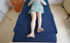 Kỳ tích kéo dài chân 13cm cho bệnh nhân ung thư xương