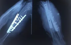 Nối thành công cánh tay gần bị đứt lìa cho người bệnh