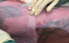 Cô gái trẻ nguy kịch do hội chứng Lyell nặng, diện tích trợt thượng bì 95% diện tích cơ thể