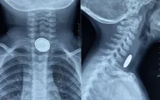 Bé 3 tuổi bị bỏng thực quản do nuốt pin cúc áo