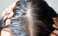 5 lý do không tưởng khiến bạn "hói" dần