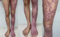 Chromoblastomycois - bệnh nhiệt đới bị lãng quên