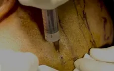 Phẫu thuật cấy tóc gây chết người ở Ấn Độ