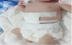 Cứu sống bé sơ sinh chào đời có ruột nằm ngoài ổ bụng