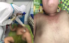 Chuẩn bị ra viện sau mắc COVID-19 nặng, bé trai xuất hiện hội chứng viêm đa hệ thống