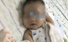 Cứu sống bé 1,5 tháng tuổi bị viêm mô tế bào hóa mủ nặng vùng má