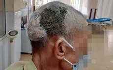 Người đàn ông nhập viện với tấm Titanium hở trên sọ não